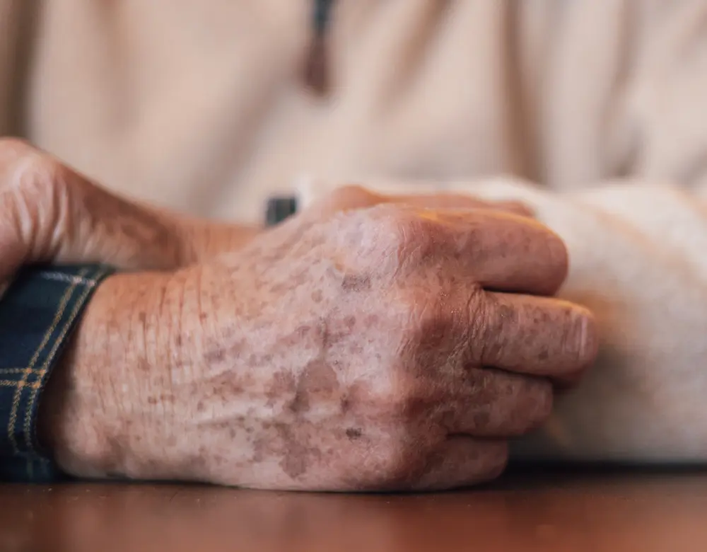 Altersflecken Altersflecken