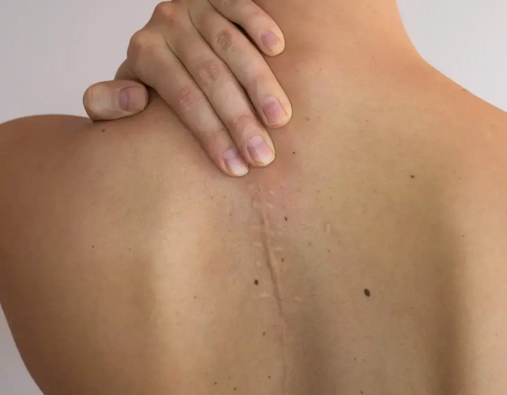 narbenkorrektur-1 narbenkorrektur-1