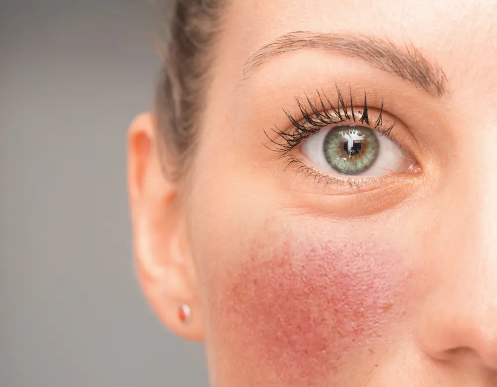 Rosacea Rosacea