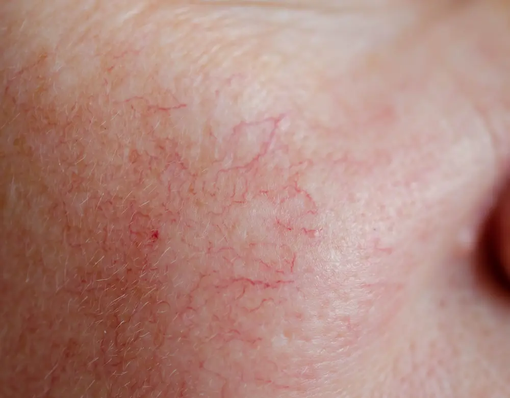 Störende Äderchen Störende Äderchen