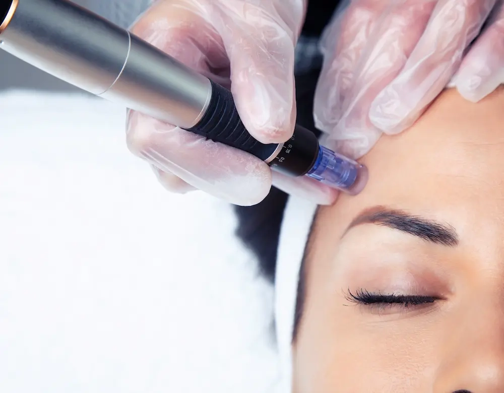 rf-needling rf-needling